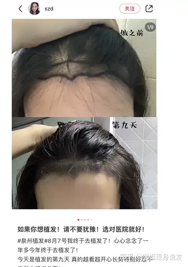 全国植发补发(植发补发价格大概是多少钱)