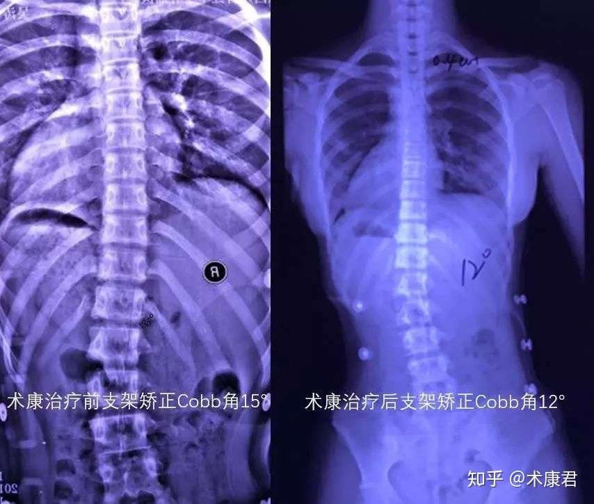 驼背 高低肩 歪脖子 15岁的脊柱侧弯女孩说 我不想开刀 知乎