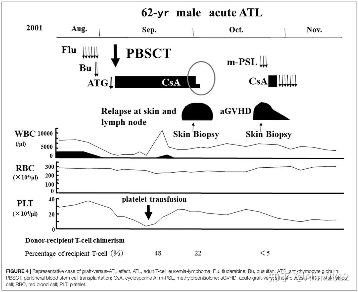 成人t细胞白血病 Adult T Cell Leukemia Atl 知乎