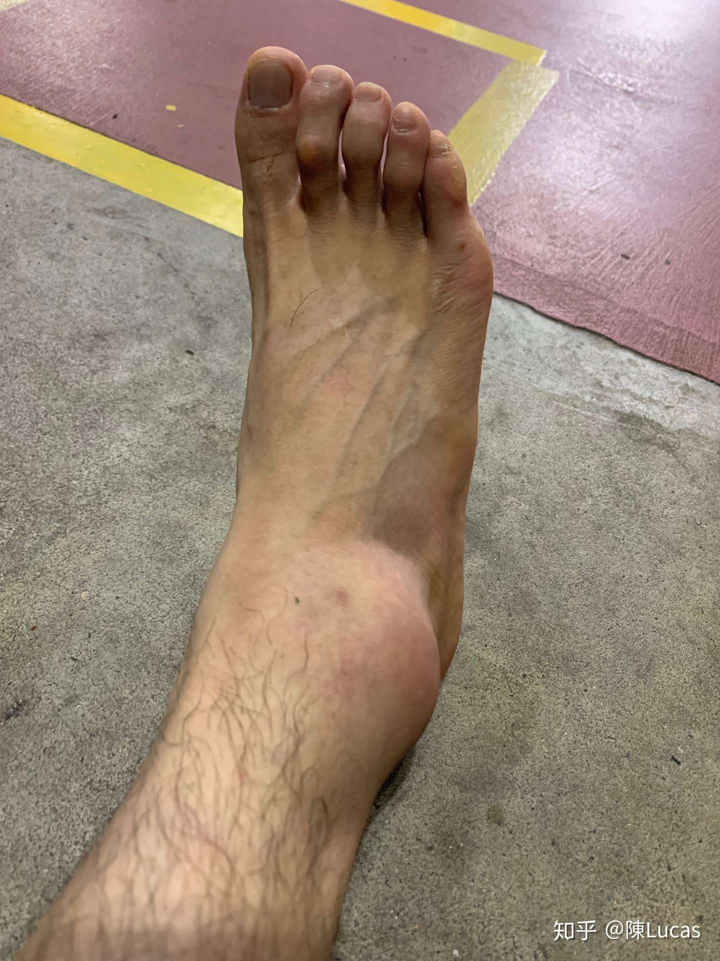 记录韧带断裂 知乎