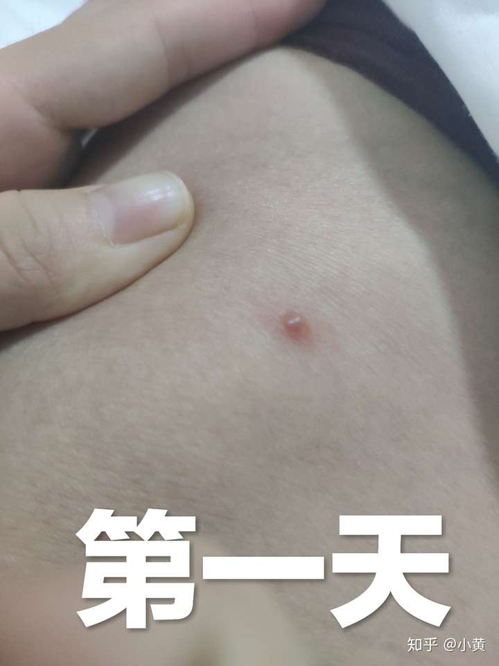 成人长水痘是什么样的经历