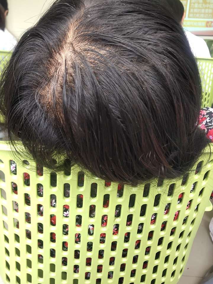 女生头顶头发少是什么体验 ?