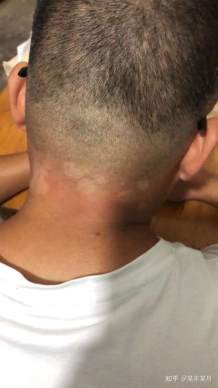 脖子后长了几团白色的是什么?