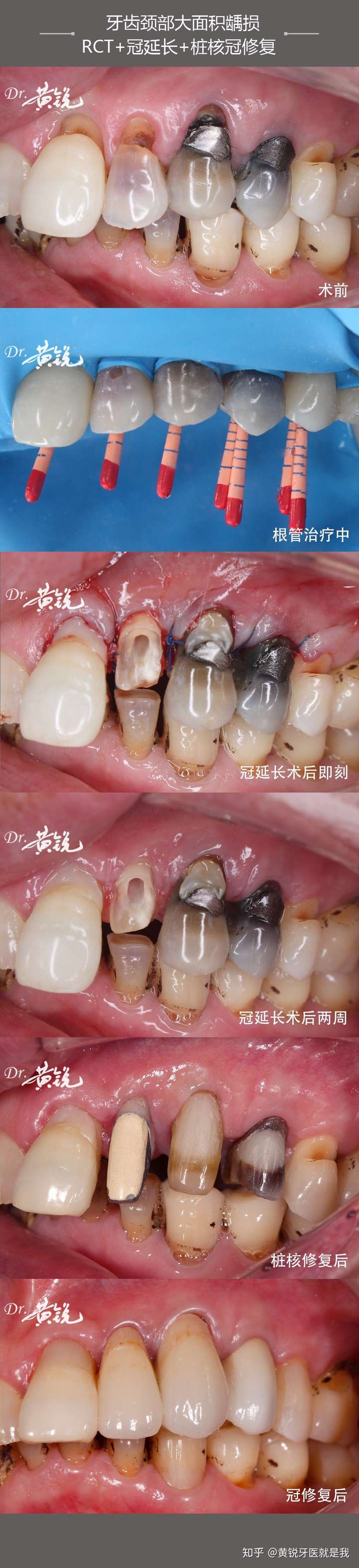 牙齿颈部大面积龋损rct冠延长桩核冠修复