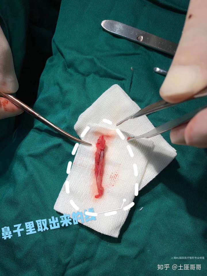 什么是线雕隆鼻