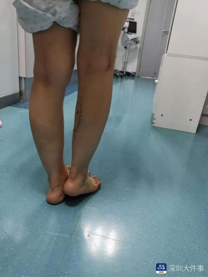 女子花一万多打瘦腿针 结果右小腿竟短了一截 知乎