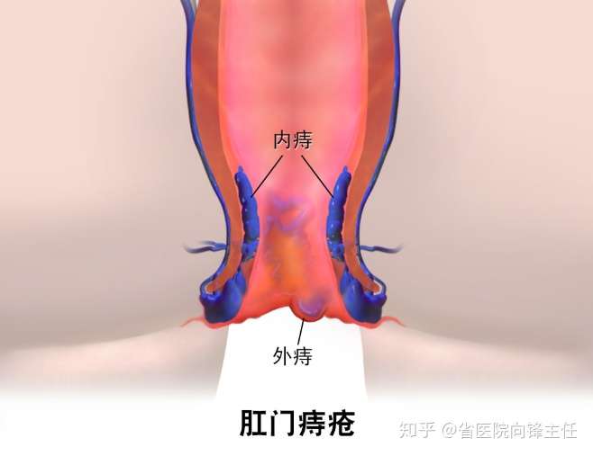 痔疮是什么样的怎么解决它