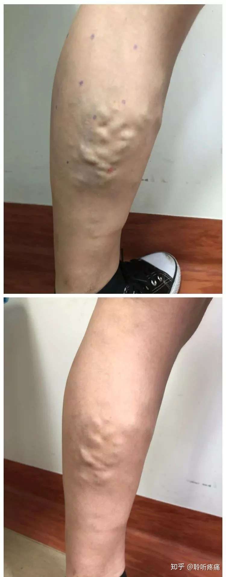 例肌筋膜疼痛触发点治疗效果总结 知乎 例肌筋膜疼痛触发点治疗效果总结 知乎