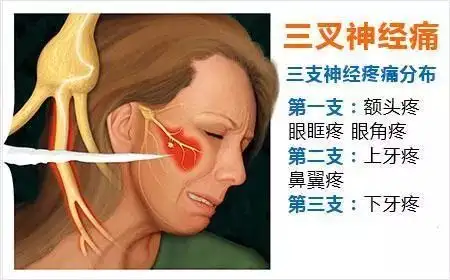 要想得到有效的治疗,必须在三叉神经痛刚开始出现症状的时候就去治疗.