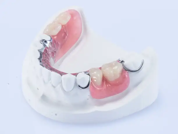 避雷！西安诺贝尔口腔医院告诉您：种牙常见的3大误区！