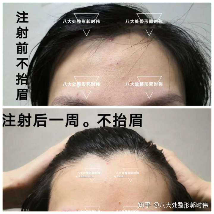 肉毒素注射八大处郭时伟系列案例十六