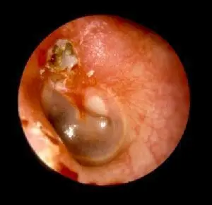 中耳胆脂瘤真的是肿瘤吗? 