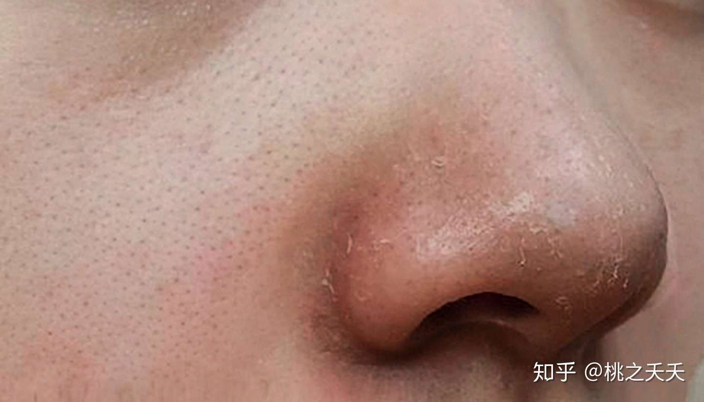 鼻子上黑头很严重 怎么办 急 知乎