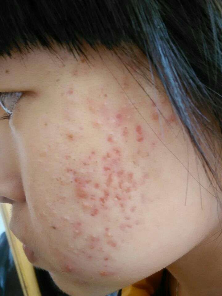 17岁女生,因为脸上的痘坑对生活失去了信心?