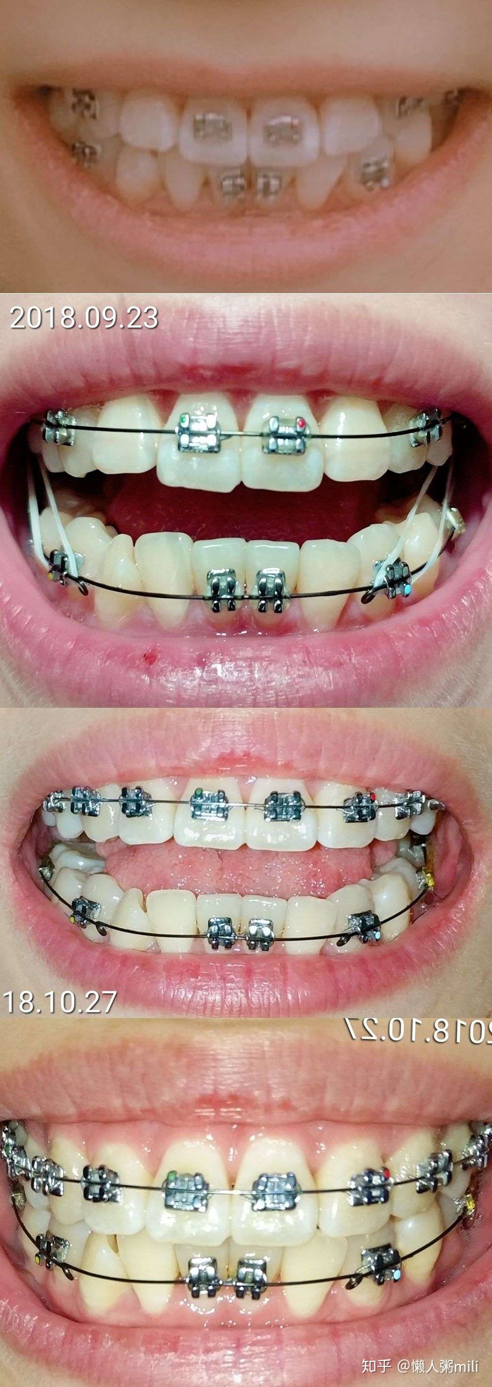 24岁拔磨牙大牙牙齿矫正记录 知乎