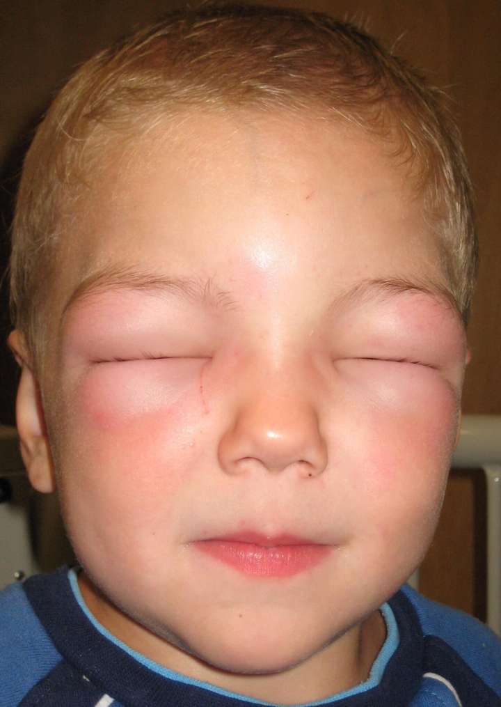 幼儿被蚊子咬肿成「面龟」!小心是过敏反应引起「血管性水肿」