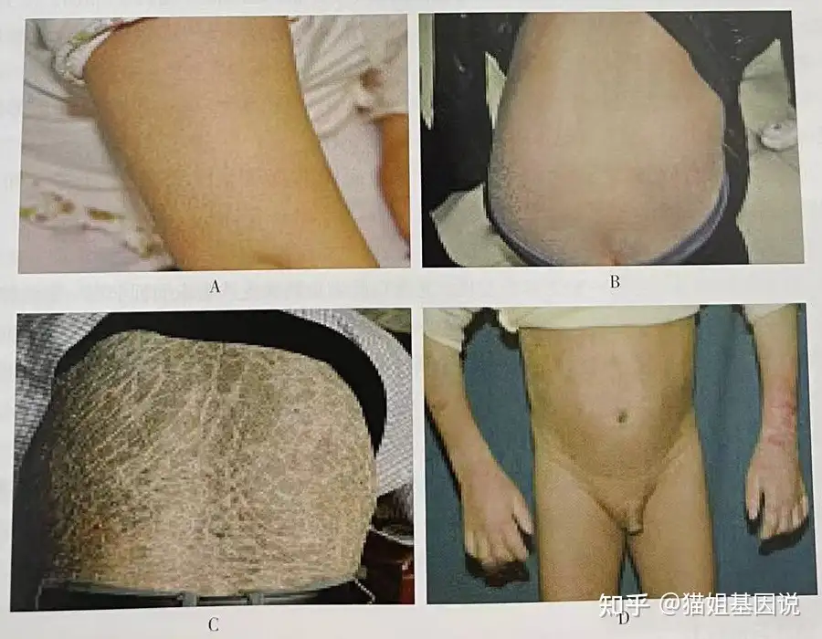 非综合型鱼鳞病的遗传咨询 知乎