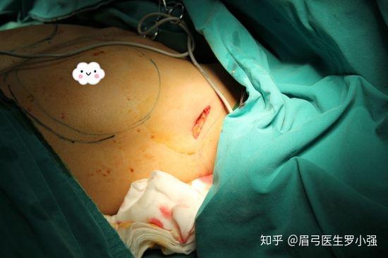 假体隆胸切口图片