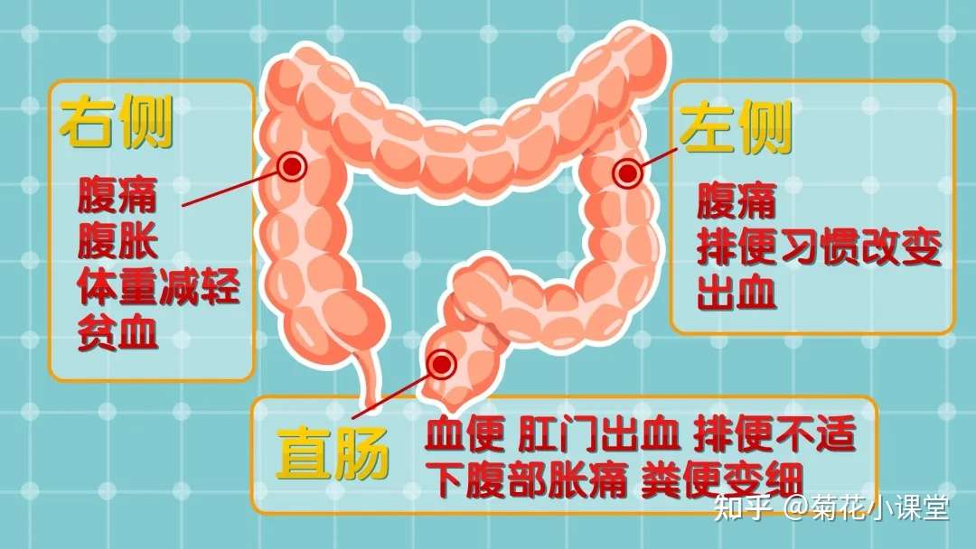 肠癌早期不痛不痒 大便出现4种异常要警惕 可能是早期信号 上完厕所别忘看一眼 知乎