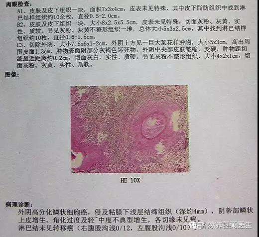外阴白斑不治疗真的会癌变吗 知乎