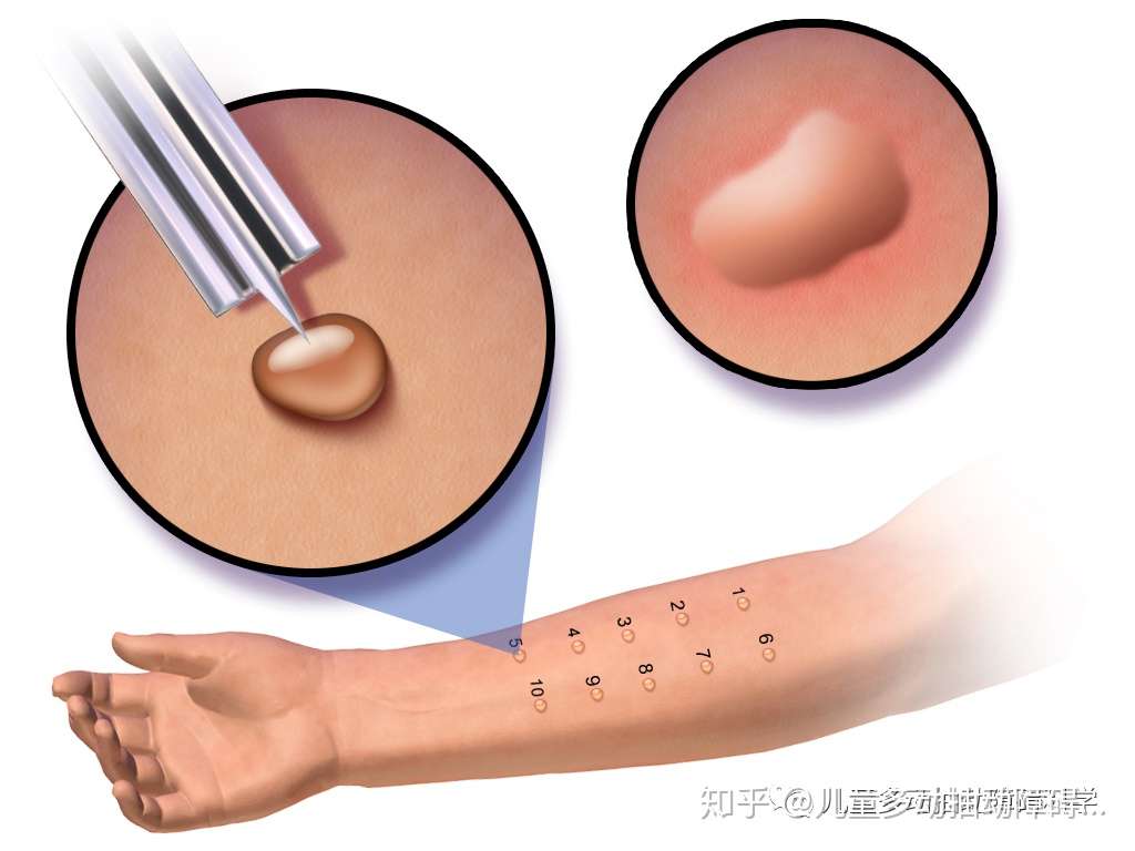 吃鱼油也会过敏 多动抽动障碍补充鱼油过敏怎么办 知乎
