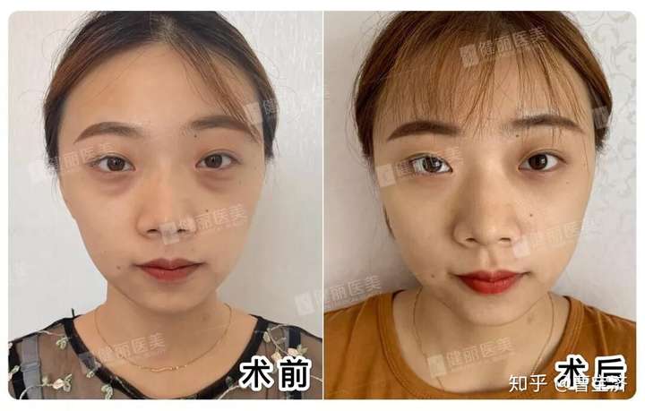 21歲眼袋重早睡也眼袋重且左眼眼袋比右眼明顯嚴重怎麼辦?