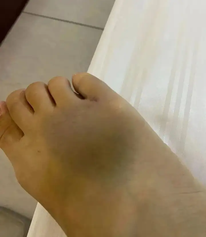 但铲屎官也万万没想到,被这货冲撞了一下后,脚背上就有了块淤青,而脚