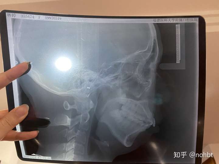 深受下巴后缩困扰,各路神仙请赐教!