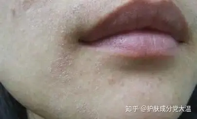 皮膚過敏怎麼辦屏障損傷如何修復和預防