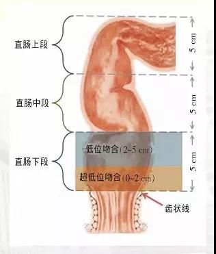 超低位直肠癌保肛手术精准功能保肛术
