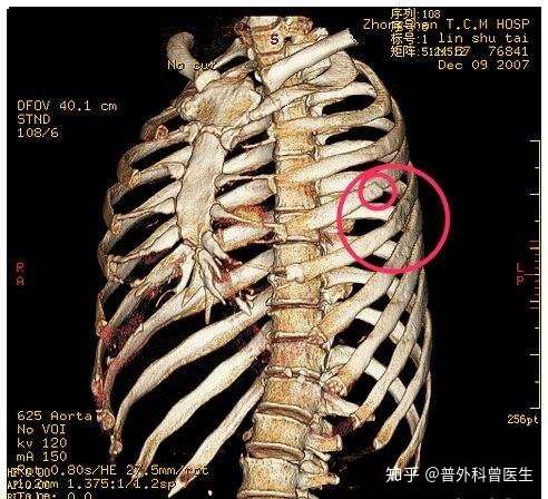 肺部ct检查 只能检查肺吗 其实 肺部ct还可以发现很多其他问题 知乎