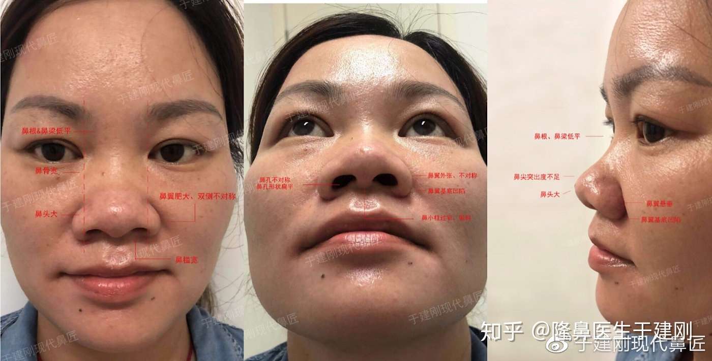 肋软骨隆鼻 大鼻头 鼻翼肥大 鼻子短塌 还有救吗 知乎