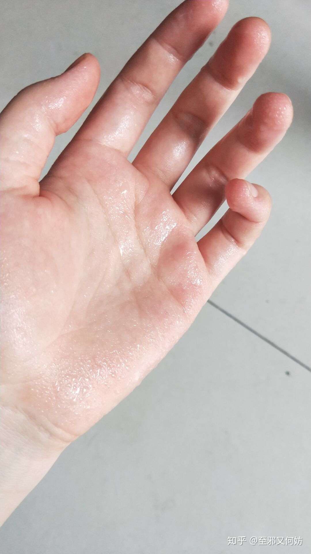 手汗症 关于手汗症以及术后的一些感想 知乎
