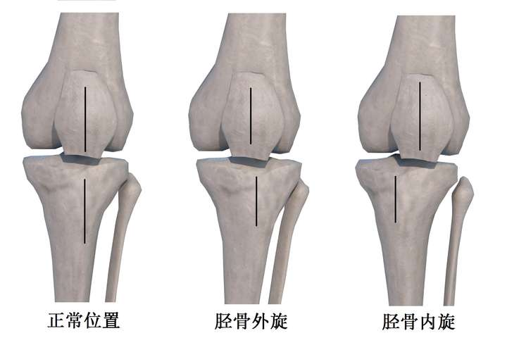 膝关节内旋和外旋图示图片