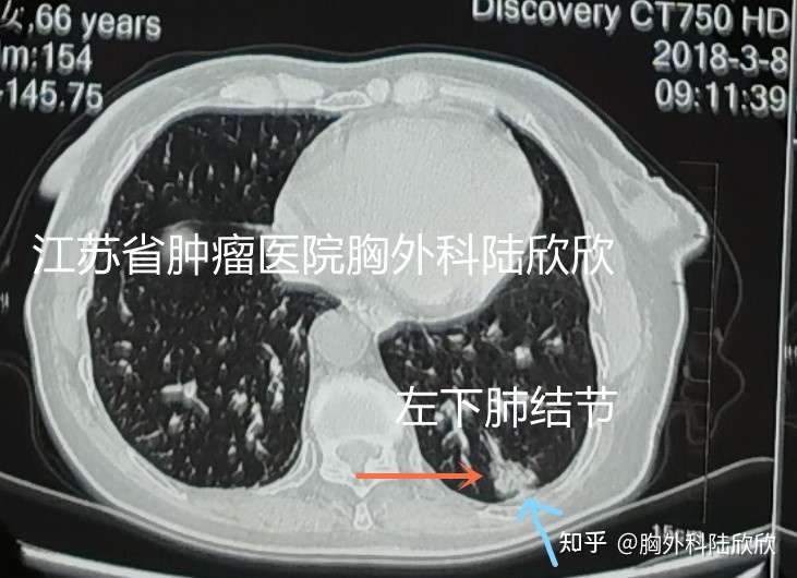 磨玻璃结节故事10 一个2厘米的恶性混合磨玻璃结节两年半来几乎不增大 知乎