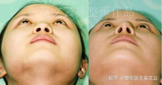 有人通过埋线缩鼻翼的吗