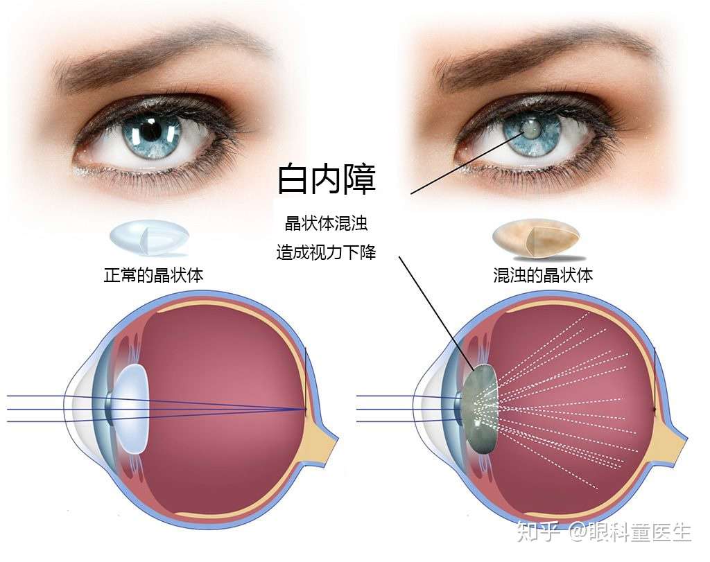 认识白内障 知乎