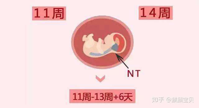 准妈妈不能错过的第一次排畸-NT插图 v2-b3dacb396298f57a946f508ca447b492_720w.jpg插图