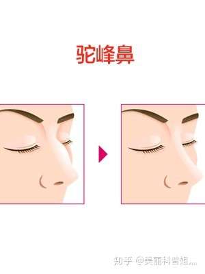 什么是驼峰鼻