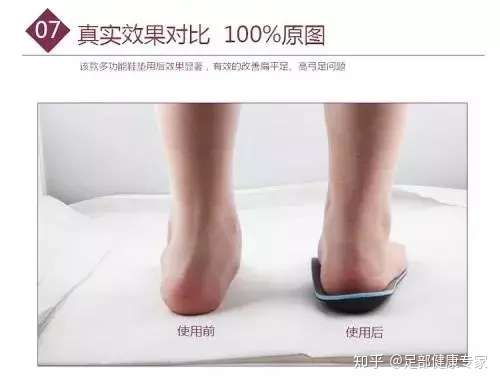 身边有高弓足的人要注意了 一定要转给身边的人看 知乎 身边有高弓足的人要注意了 一定要转给身边的人看 知乎