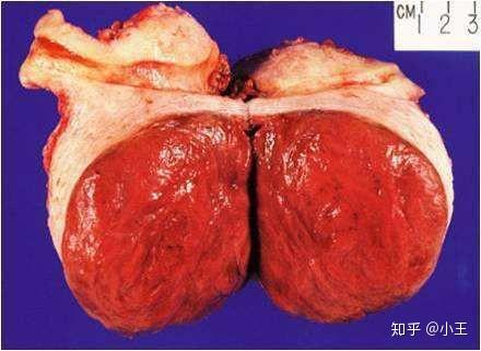 叶状囊肉瘤图片