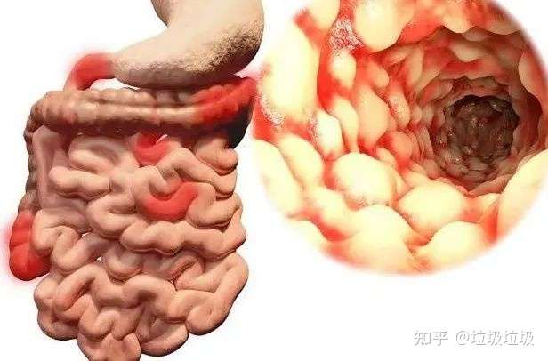 直肠炎的七个内幕 知乎