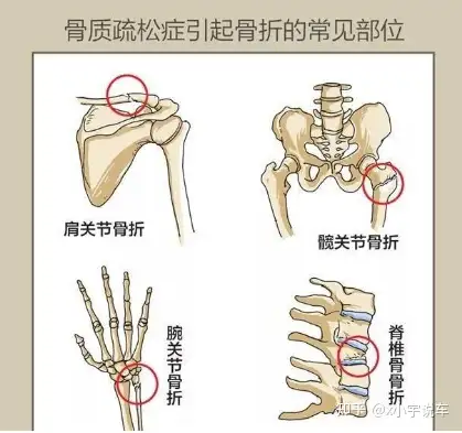 和骨折凱一起了解髖骨骨折