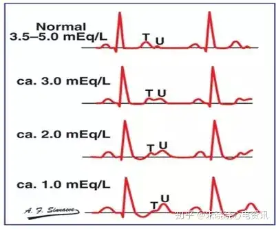 但由于t波和u波难以分辨,故表现为qu间期延长,而实际的qt间期是正常的