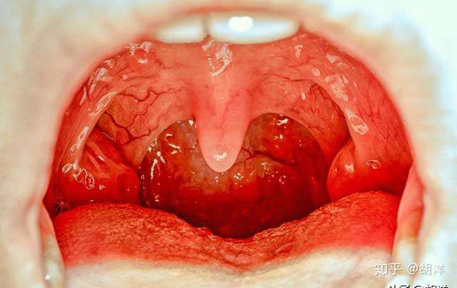 扁桃体虽小 竟然也会生癌 东方艳后确诊该病 一习惯是罪魁祸首 知乎