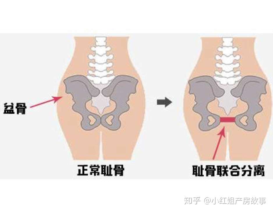 孕妇耻骨疼不当回事 产前瘸着进医院 无奈只能剖宫产 知乎