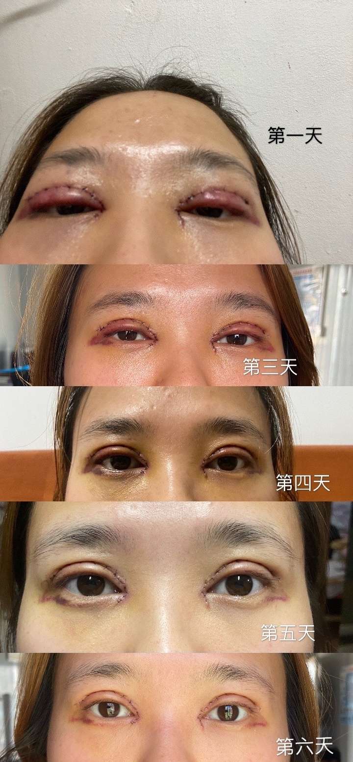 全切双眼皮手术开眼角