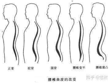 腰椎间盘突出症(后突型)分两种状况:腰曲变直和腰曲过大,所以锻炼方法