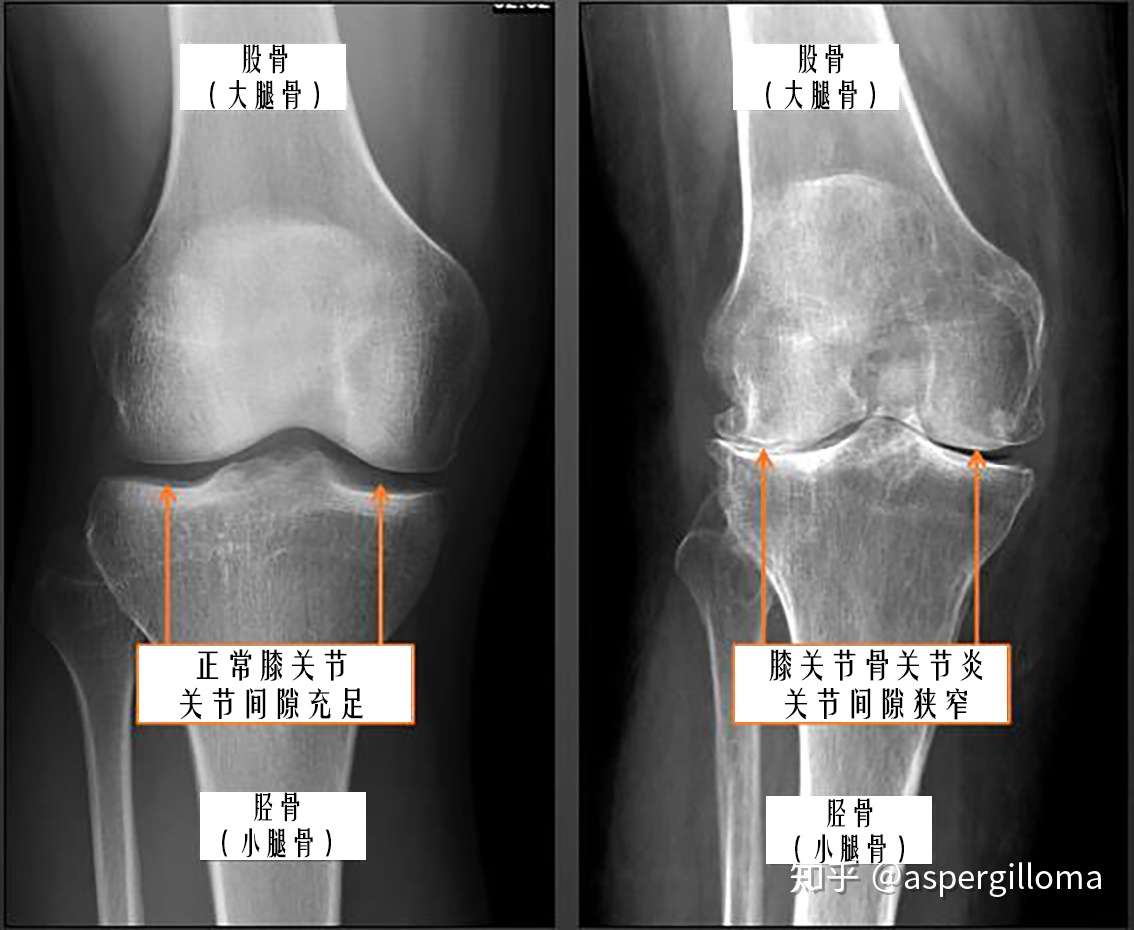 膝关节疼痛难忍 长 骨刺 了该怎么办 知乎