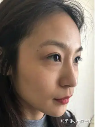 千万别打童颜针看本姑娘分享童颜针一个月后效果图惊